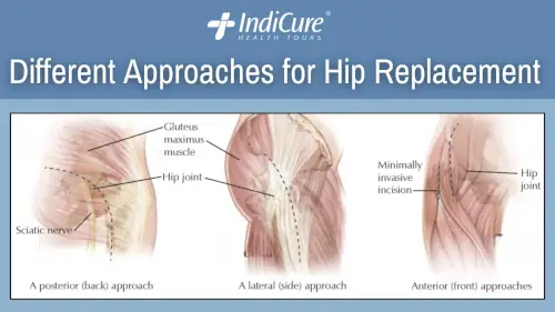 Different Approaches for Hip Replacement